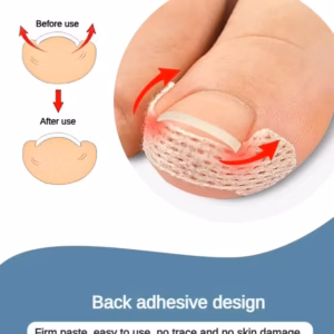 Ingrown Toenail Corrector Patches Treatment Recover 40 pcs Nail Correction Stickers