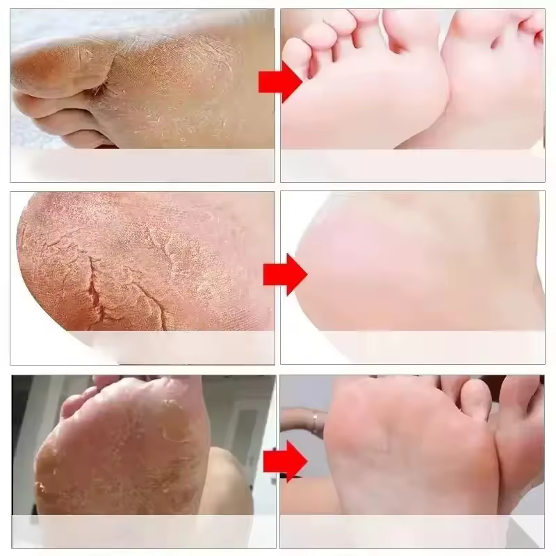 Foot Cream Heel Cracking Repair Products Exfoliation Dead Skin Removal - Image 2
